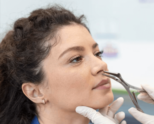 Nasolabial Fold Softening