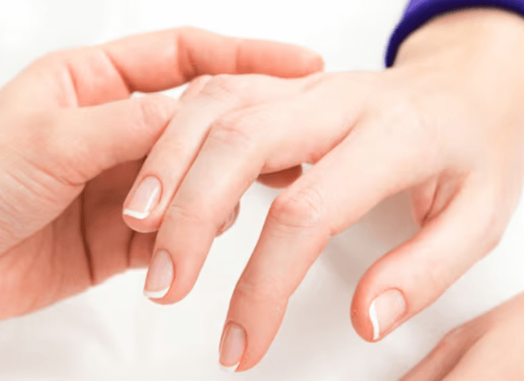 Radiesse Hand Rejuvenation