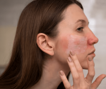 Redness Reduction Fraxel