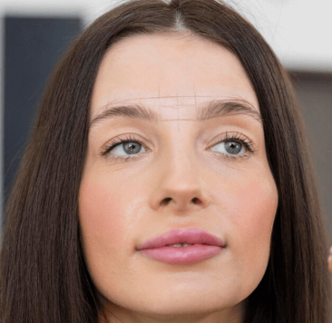 Refined Forehead Contouring Fillers