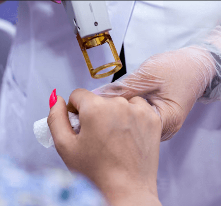 Restylane Hand Filler Treatment