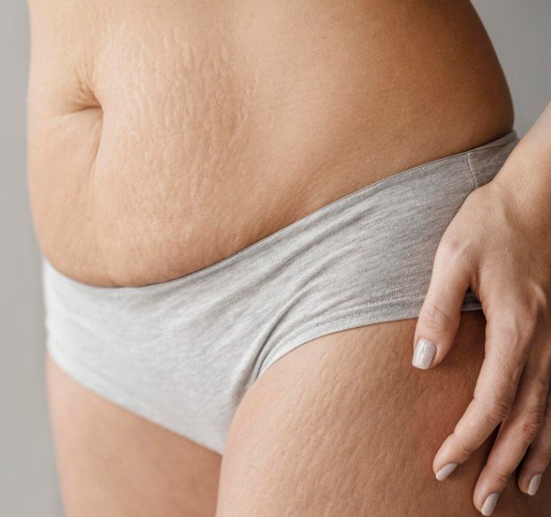Secret RF Stretch Mark Treatment