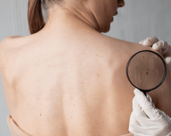 Back Acne