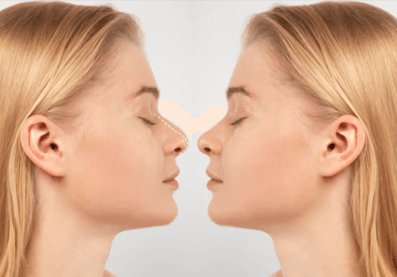 Golden Ratio Nose Contouring