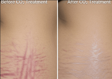 Stretch Mark Removal CO₂