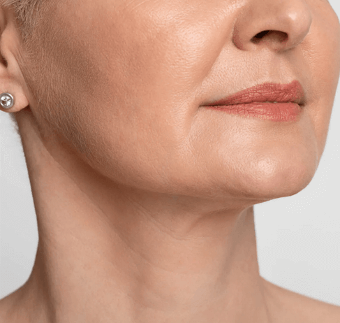 Subdermal Neck Rejuvenation