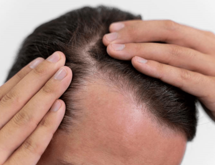 Thinning Hair PRP Therapy