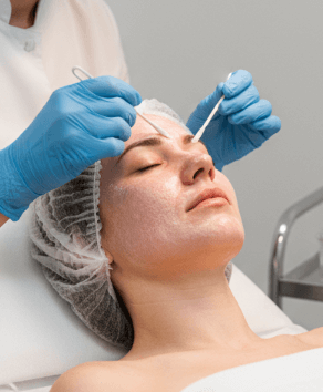 Trichloroacetic Acid Peel