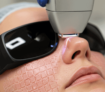 Deep CO2 Resurfacing