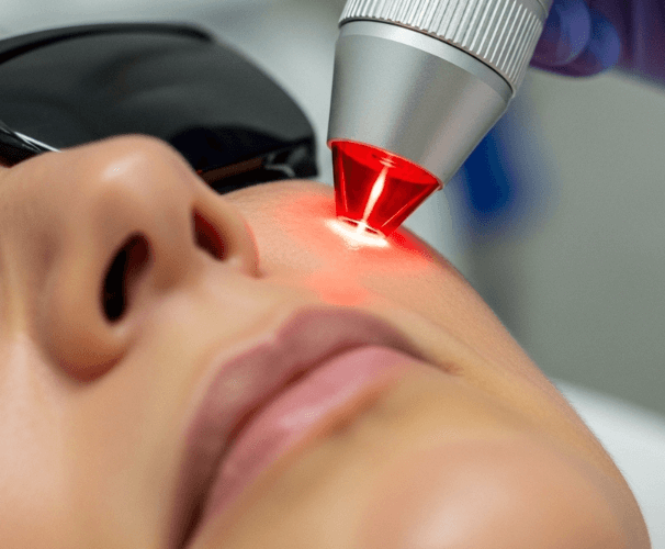 Q-Switched Ruby Laser