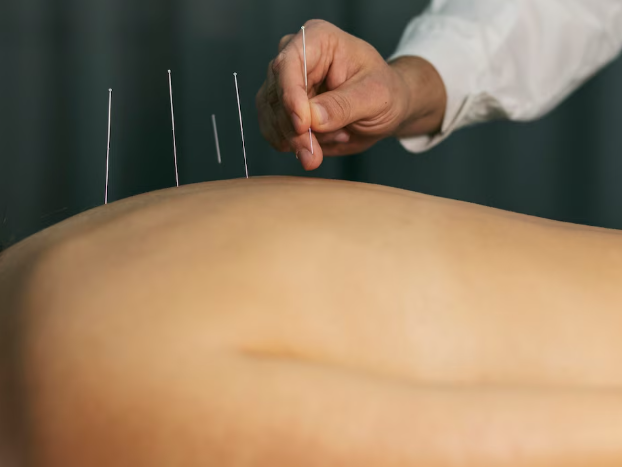 Acupuncture Balancing Therapy