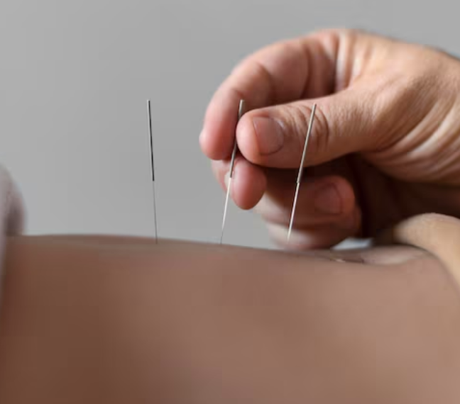 Acupuncture Therapy for Dysmenorrhea