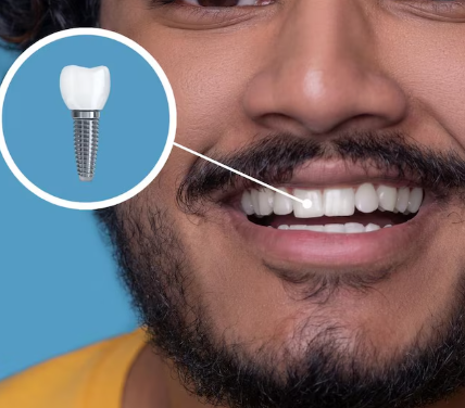 Affordable Mini Dental Implants