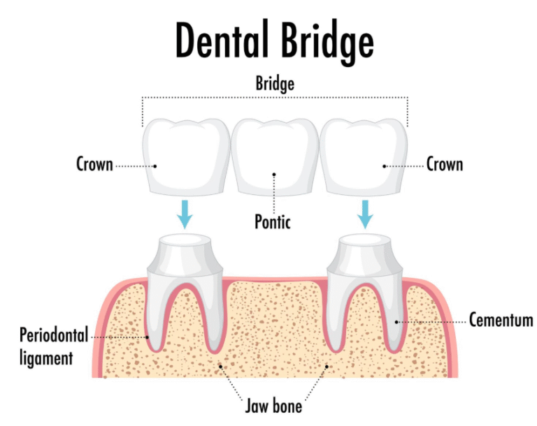 Bridge-on-Implant