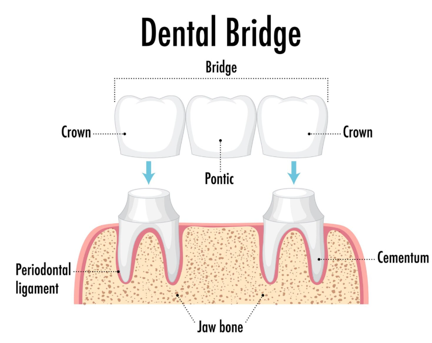 Bridge-on-Implant