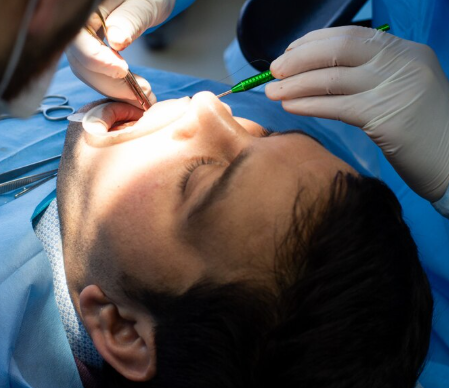 Microsurgical Gum Grafting