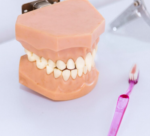 Bar Retained Implant Dentures