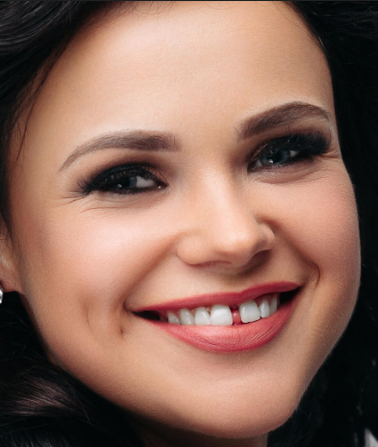 Lateral Sinus Lift Bone Grafting