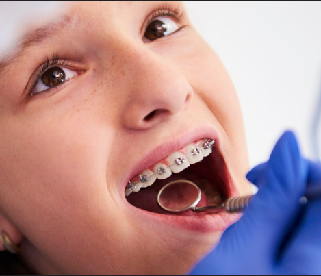 Bracket Bonding System