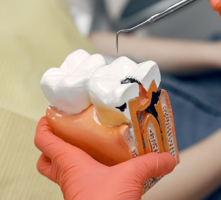 Ceramic Dental Cap Treatment