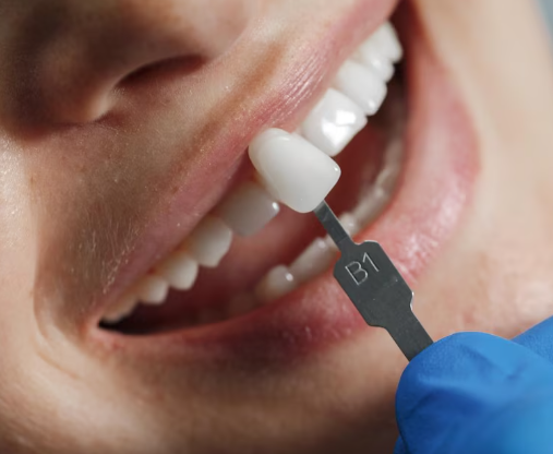 Fixed Hybrid Implant Dentures