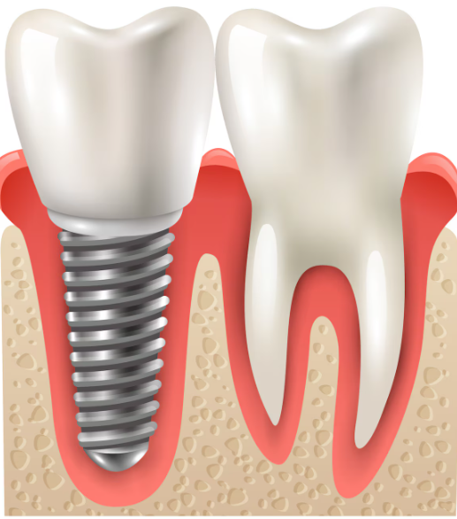 Ceramic Implant-Supported Bridge