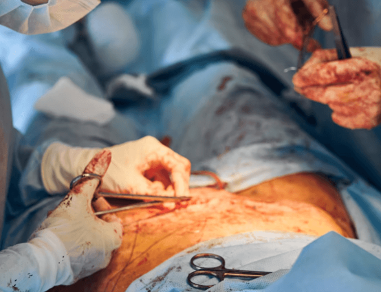 Deep Infiltrating Endometriosis Surgery