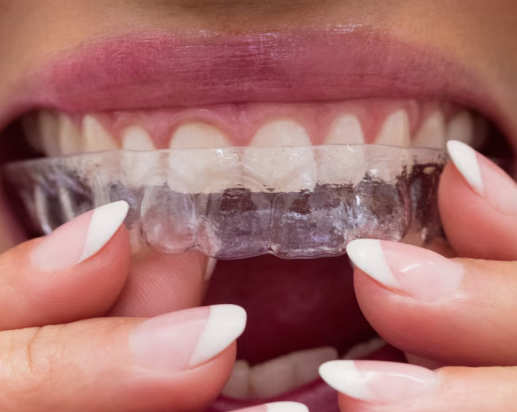 Digital Clear Aligners