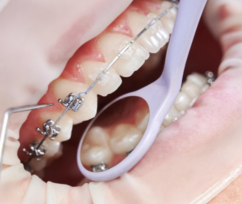 Elite Lingual Braces