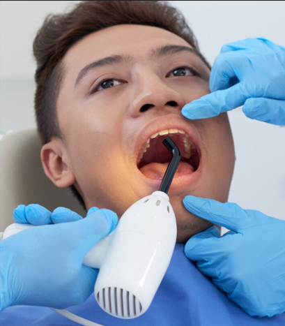 Aesthetic Bonding Veneer Makeover