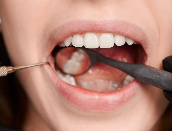 Enamel-Bonded Esthetic Fillings