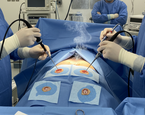 Endometriosis Laparoscopic Excision Surgery