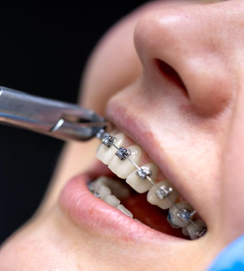 Fast Metal Braces Correction