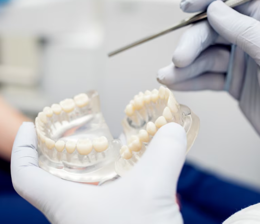 Mini Implant Retained Crown