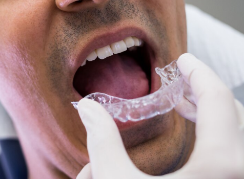 Fast Track Clear Aligners