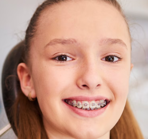 High-Torque Metal Braces