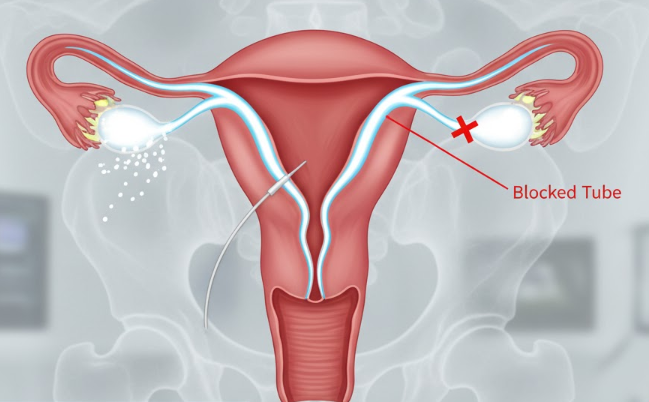 Laparoscopic Bladder Neck Suspension