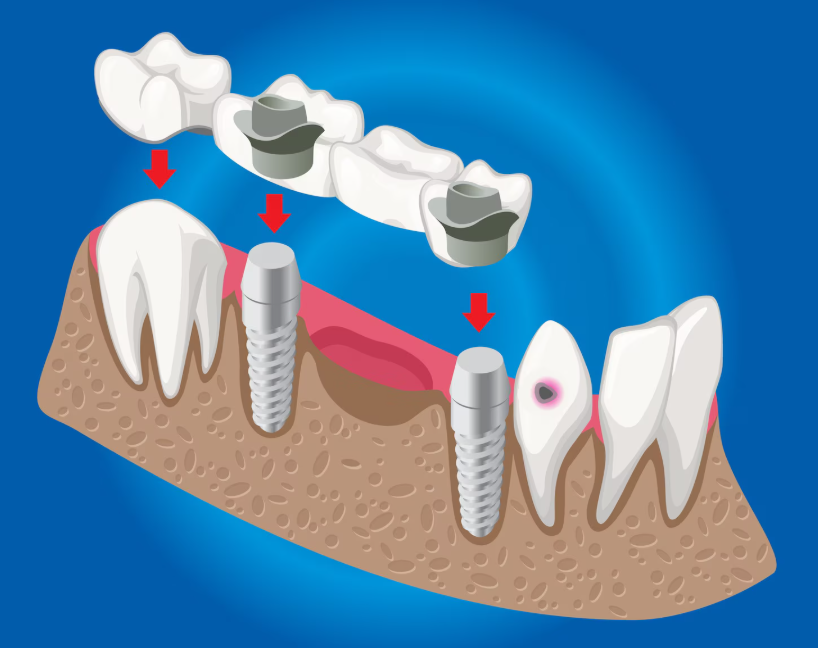 All-on-4 Implant Dentures