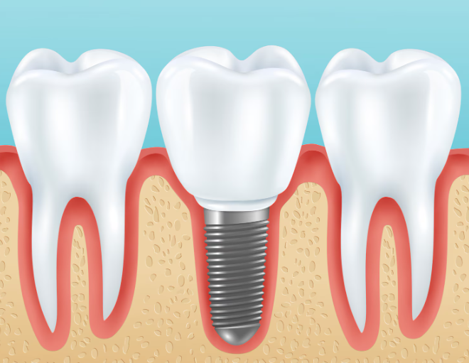 Implant Retained Full Denture