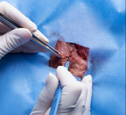 Single-Port Laparoscopic Ovarian Cyst Removal