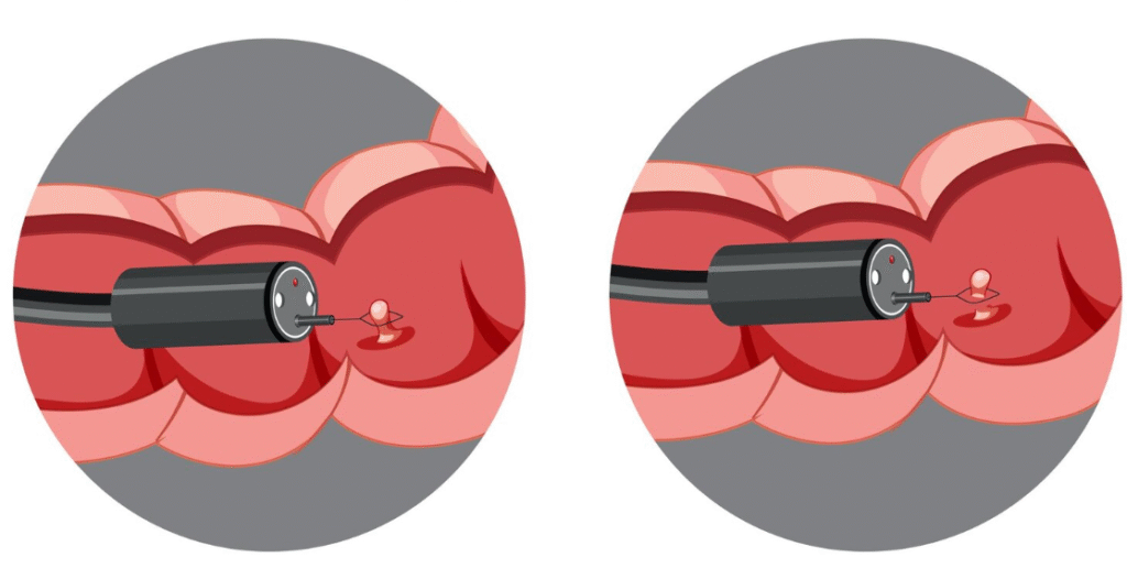 Micro-Hysteroscopy Polypectomy