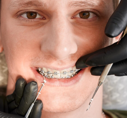 Gold Standard Aligners