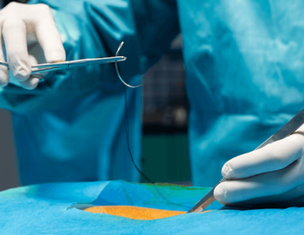 Microsurgical Laparoscopic Ovarian Cyst Removal