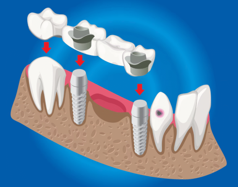 Mini Dental Implants