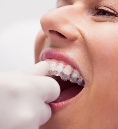 K-Digital Clear Aligners