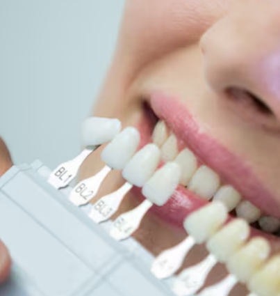 Nano-Ceramic Veneers