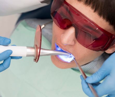 Nano-Hybrid Composite Fillings