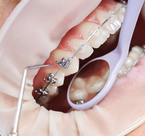 Nickel-Free Metal Braces