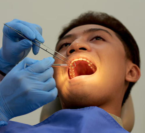 Non-Surgical Root Canal Treatment