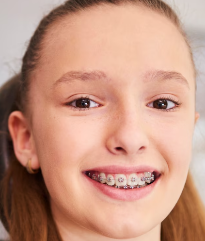 Motion Clear Aligners